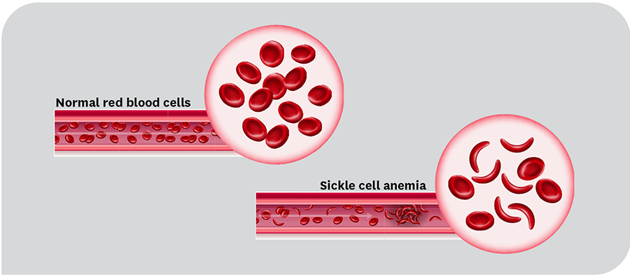 Normal red blood cells vs. Sickle cell anemia